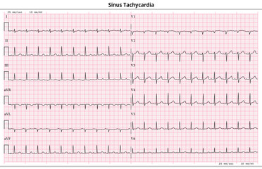 ECG Sinus Tachycardia - 12 Lead ECG Common Case - 6 Sec/lead - Vector Illustration