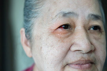 Close-up of older female eyes with red inflamed and dilated capillaries.