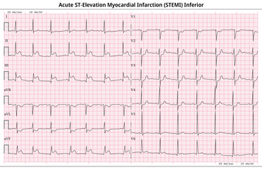 ECG Acute STEMI (ST-Elevation Myocardial Infarction) - 12 Lead ECG Common Case - 6 Sec/lead - Vector Illustration