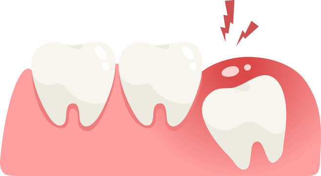 Illustration of pain cause of wisdom tooth under gum.