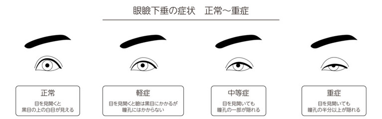 医療イラスト、眼瞼下垂の症状　正常～重症