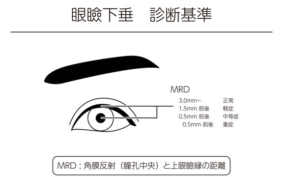 医療イラスト、眼瞼下垂の診断基準の図解イラスト