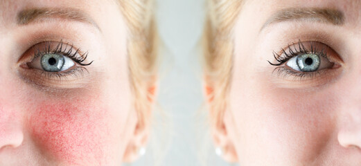 Before and after laser treatment for rosacea