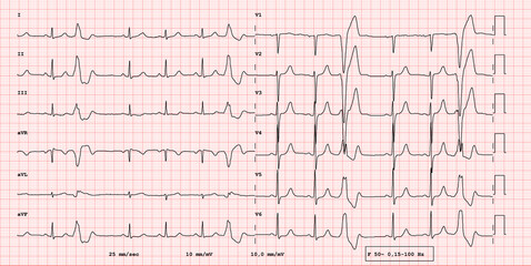 ECG example of 12-lead rhythm,  Wide QRS supraventricular extrasystole, real exam