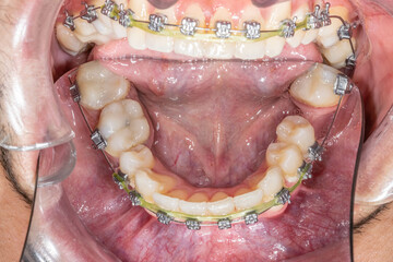 Dental orthodontics patient. Mirror indirect occlusal view of the mandibular arch with metal...