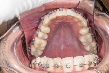 Dental orthodontics patient. Mirror indirect occlusal view of the maxillary arch with metal...