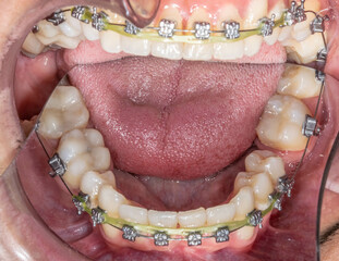 Dental orthodontics patient. Mirror indirect occlusal view of the mandibular arch with metal...