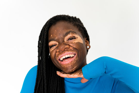 Vitiligo woman portrait
