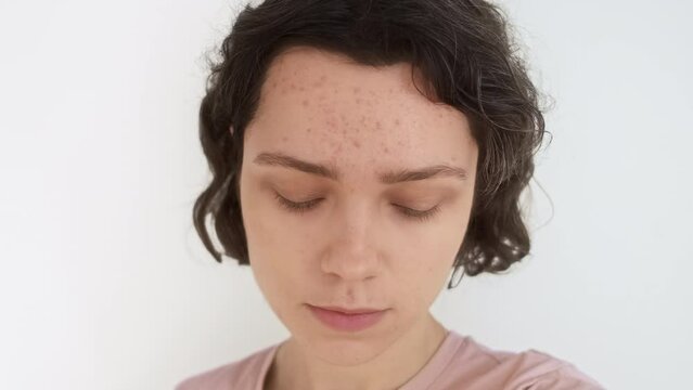Young beautiful woman with problematic skin looks at camera like in mirror. Sad girl is shy about acne on face and tries to smile. Stages of acne treatment. Skin with acne scars before salon treatment
