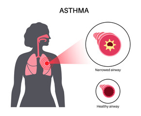 Asthma lung disease - obrazy, fototapety, plakaty