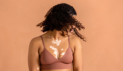 Vitiligo woman portrait