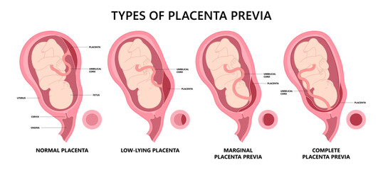 uterus contraction baby of vasa fetal infant born c section nuchal cord twins fetus defect vessels funic labor growth low lying birth fluid of test increta cervix Bilobed sac neck knotted preterm