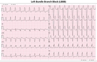 ECG LBBB (Left Bundle Branch Block) - 12 Lead ECG Common Case - 6 Sec/lead - Vector Illustration