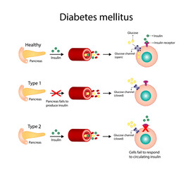 Diabetes mellitus type 1, pancreas's failure to produce enough insulin and type 2, cells fail to respond to insulin (Insulin resistance). Result in high blood glucose levels. Vector illustration