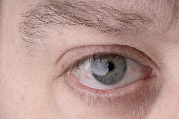 blue eye with reddened cornea of man