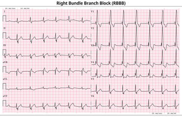 ECG RBBB (Right Bundle Branch Block) - 12 Lead ECG Common Case - 6 Sec/lead - Vector Illustration