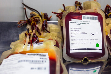 Leukocyte poor pack red cell in transfusion bag on a tray inside blood bank.Label as O Rh plus.Rare blood group prepares for donation or therapy of anemia patient in hospital.Many plastic bags.