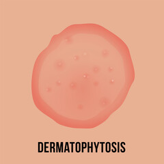 Dermatophytosis skin with fungal infection medical infographic scheme vector flat illustration
