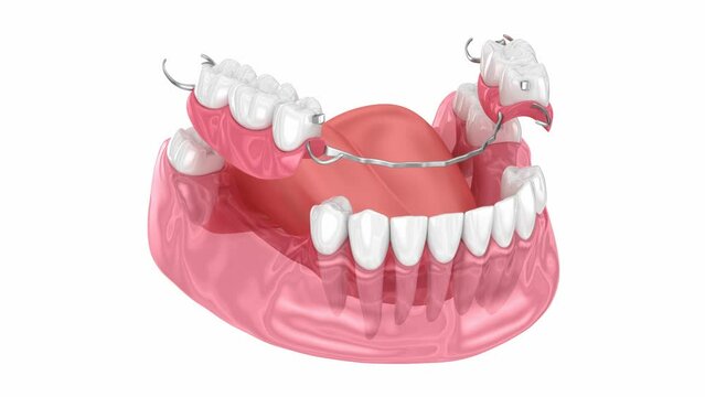 Removable partial denture, mandibular prosthesis. 3D animation