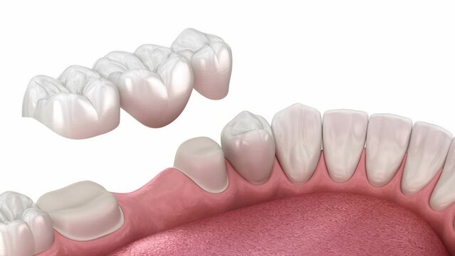 Dental bridge placement. 3D animation