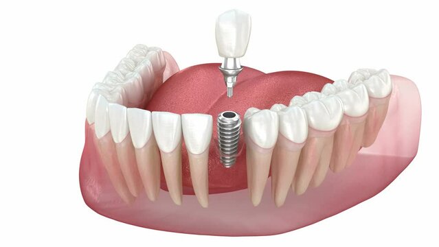 Dental implant installation and crown placement. 3d animation