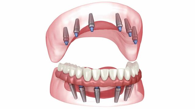 Prostheses supported by 6 implants. Dental 3D animation