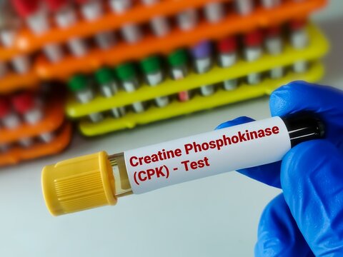 Biochemist holding blood sample for Creatinine Phosphokinase (CPK) test. Creatinine Kinase. Myositis.