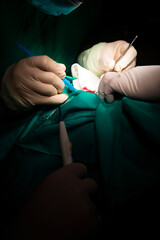 Surgeon's hands operating on a dermatological lesion