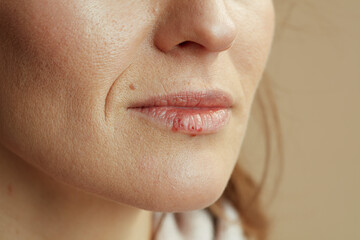Closeup on woman with herpes on lips against beige background
