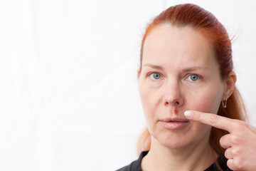 Herpes above upper lip in woman. portrait of middle aged woman with problem skin, on light background. woman pointing finger at infectious inflammation of face caused by herpes simplex virus. - obrazy, fototapety, plakaty