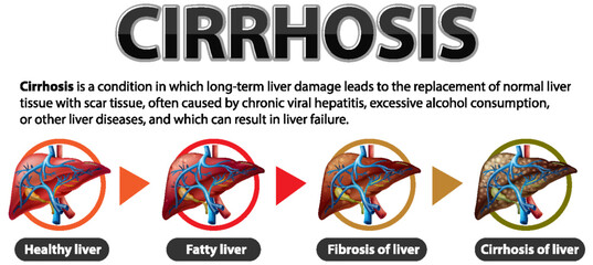 Informative poster of alcoholic liver disease Cirrhosis