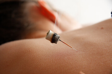 Acupuncture Session