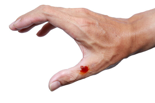 Hand wounds and bleeding