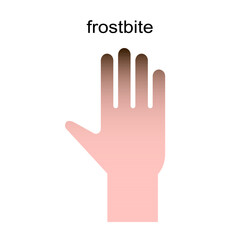 Obraz premium Frozen hand with fingers vector illustration. Medical frostbite. Skin burn symptom.