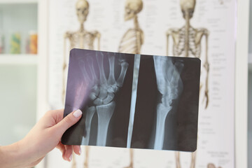 Hand of woman holding x-ray of wrist against skeletons