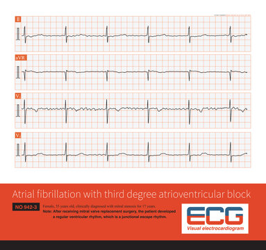 Cardiac surgery is one of the common causes of iatrogenic atrioventricular block. Once atrial fibrillation exhibits a slow and regular ventricular rhythm, it is important to be alert to 3° AVB.