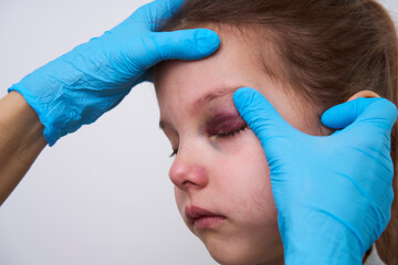 Doctor checking girl eye with bruise, close-up