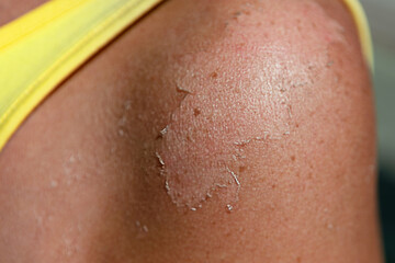 Fototapeta premium Peeling skin on the shoulder after sunburn 
