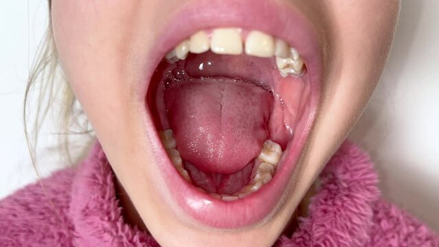Child girl or teenage girl of eleven years old opens the mouth wide and shows the teeth, gums and throat the doctor. Concept of orthodontics, dental health, braces, otolaryngologist.