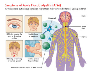 Medical illustration of Symptoms of Acute Flaccid Myelitis (AFM), with annotations. - obrazy, fototapety, plakaty