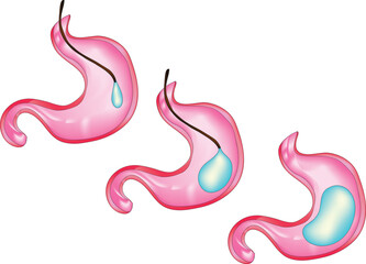 Balloon stomach weight loss