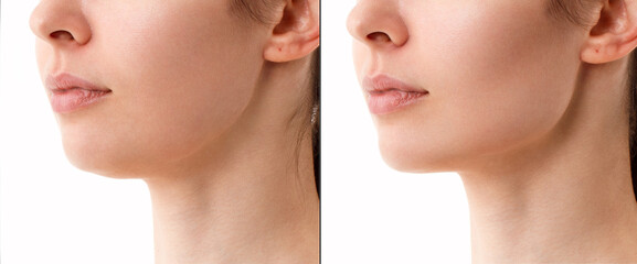 Close-up portrait of a woman before and after a chin correction procedure with neck liposuction....