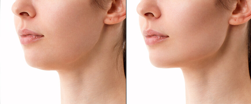 Close-up portrait of a woman before and after a chin correction procedure with neck liposuction. Fillers on the cheekbones and chin. The result of the procedure in a plastic surgery clinic.