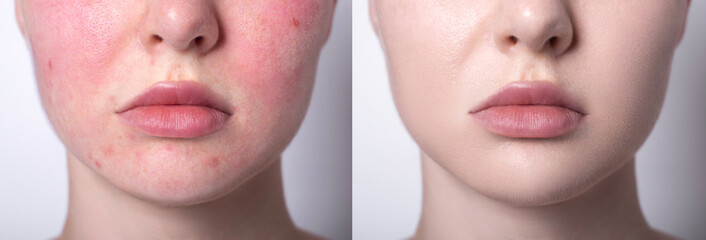 Rosacea couperose redness skin treatment, before and after result of IPL laser treatment, red spots...