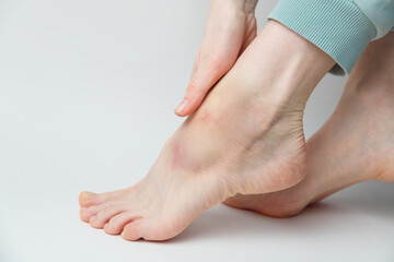 Sprained ankle with bruise and swelling on a female left foot on white background