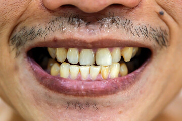 patient before prophylactic treatment, dirty brown teeth