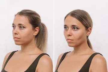Foto op Canvas Young blonde woman's face before and after plastic surgery buccal fat pad removal isolated on a white background. A lower part of face with clear highlighted cheekbones. Result of cosmetic surgery © Марина Демешко