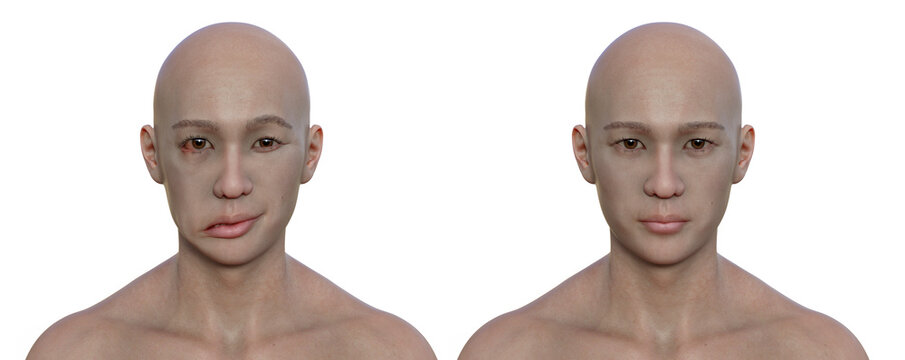 Facial palsy in a man and the same healthy man, 3D illustration showing the asymmetry and drooping of the facial muscles on one side of the face