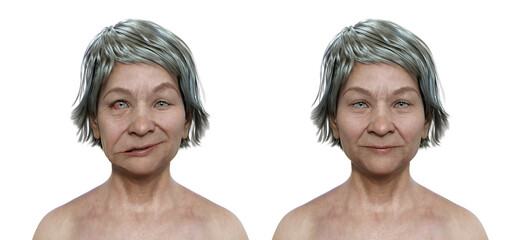 Facial palsy in a woman and the same healthy person, 3D illustration showing the asymmetry and drooping of the facial muscles on one side of the face - obrazy, fototapety, plakaty