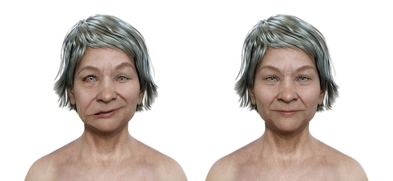 Facial palsy in a woman and the same healthy person, 3D illustration showing the asymmetry and drooping of the facial muscles on one side of the face